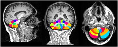 A Comprehensive Approach to Disentangle the Effect of Cerebellar Damage on Physical Disability in Multiple Sclerosis